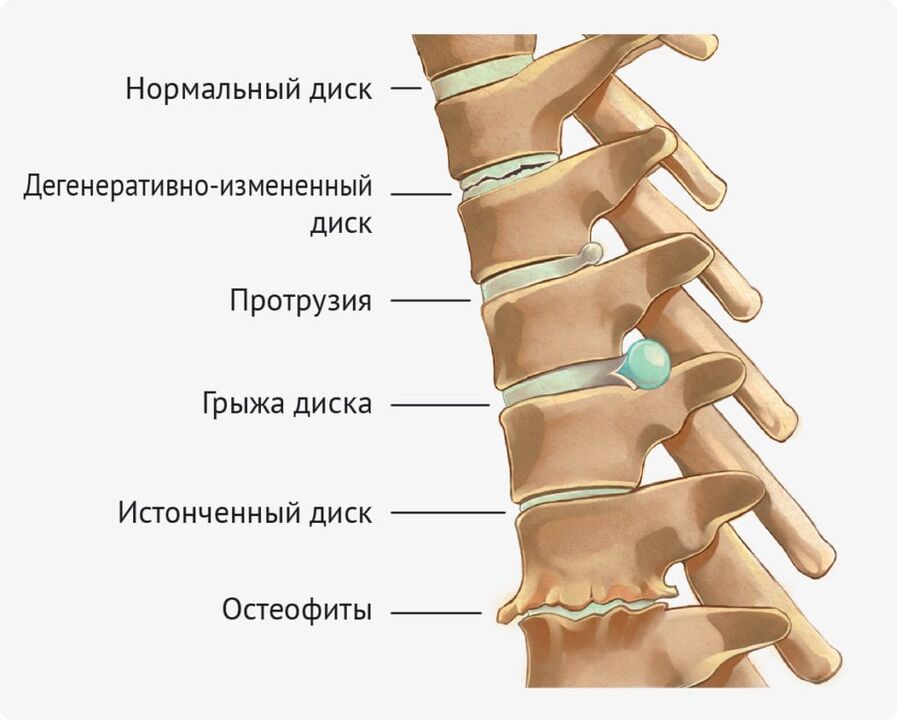 Deformidades de descuento para la osteocondrosis lumbar