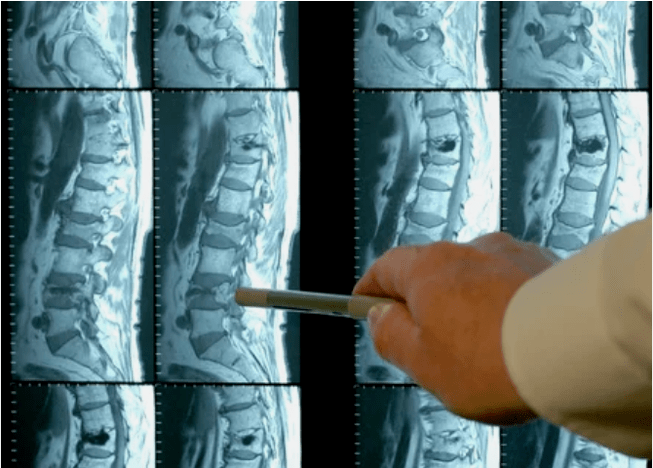 Variedades de osteocondrosis en la columna