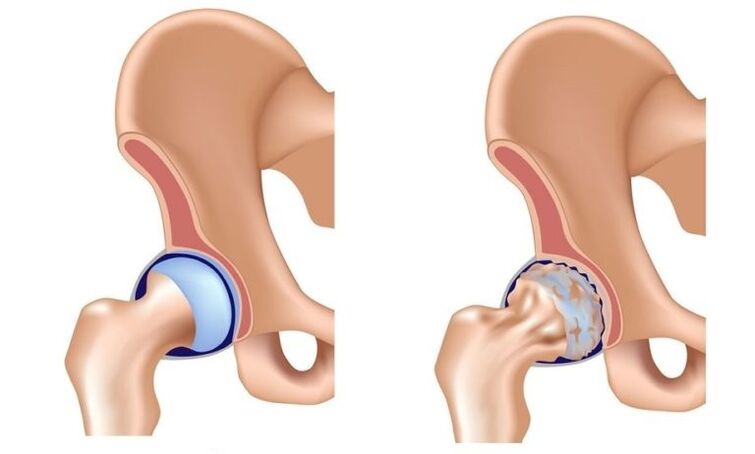 Articulación y articulación sana con osteoartritis