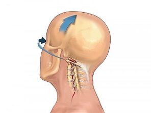 Cómo se manifiesta la osteocondrosis de la columna cervical