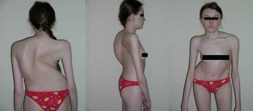 Craumático de la columna como resultado de la osteocondrosis