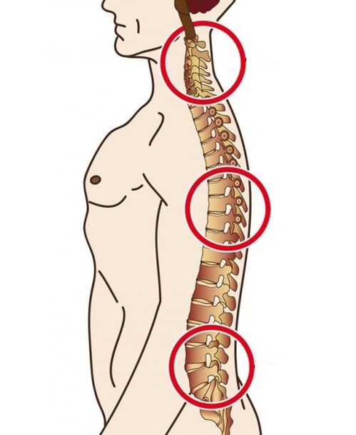 Departamentos de la columna en los que ocurre la osteocondrosis