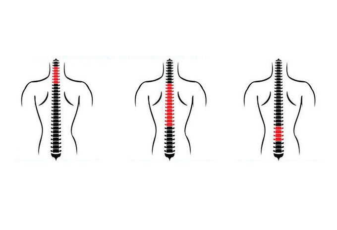 ¿Cómo se manifiesta la osteocondrosis