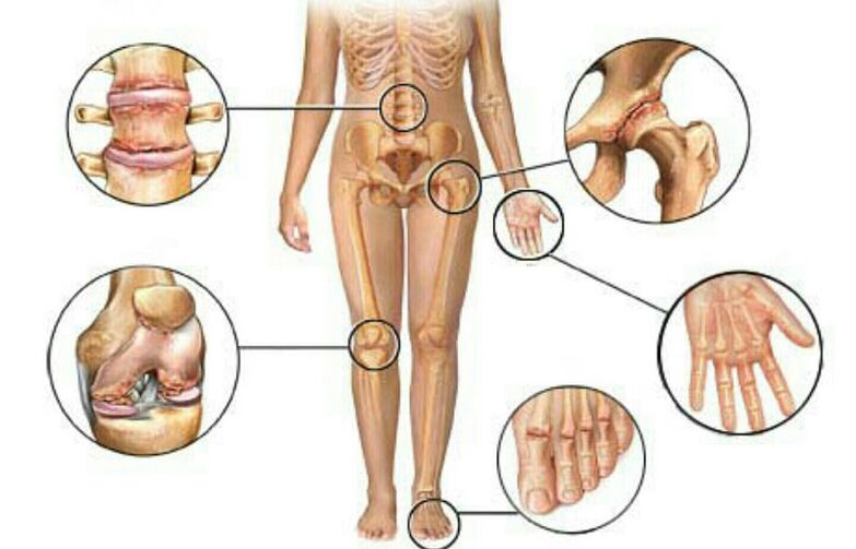 Tipo y grado de osteoartritis.